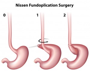 antireflux surgery (Nissen Fundoplication) 