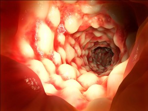 Crohns Ulcerative Colitis