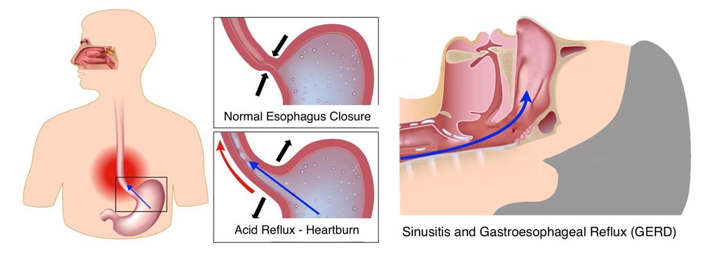 upper stomach reduce how Dave Reflux Gastroesophageal â€” Dr. Disease Mona (GERD)