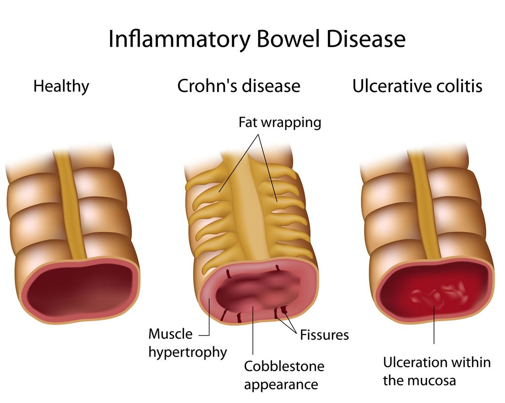 Crohn's and UC