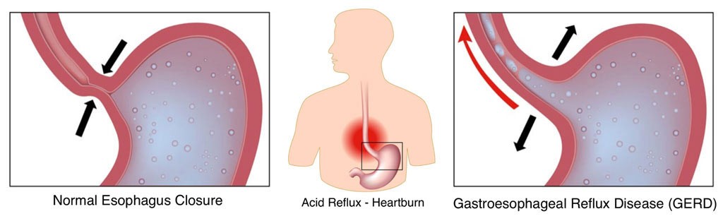 Acid reflux disease on throat