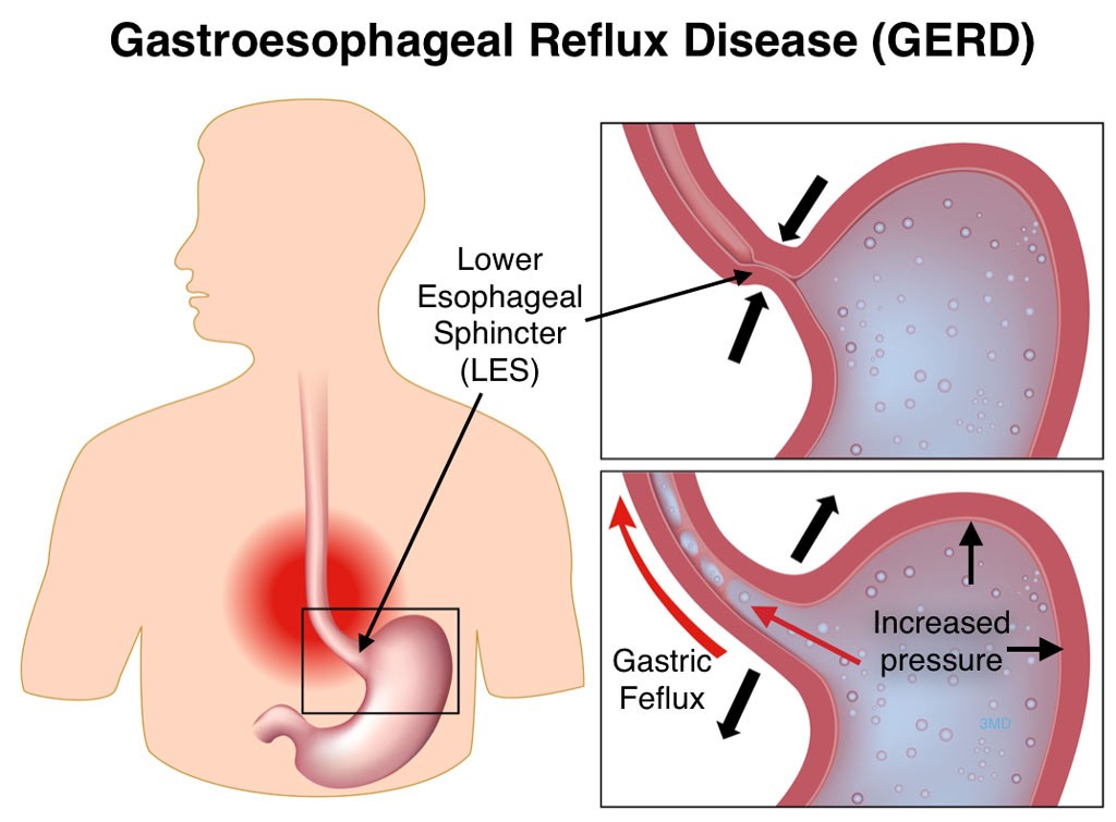 gastroesophageal reflux is treated by Dr Dave