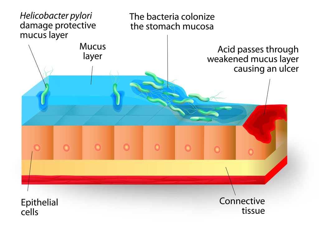 stomach ulcers