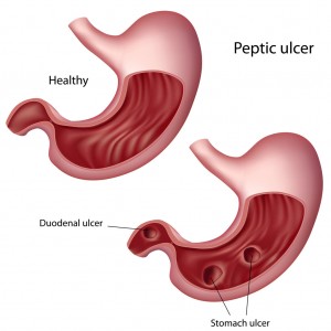 Dr Mona Dave peptic ulcer