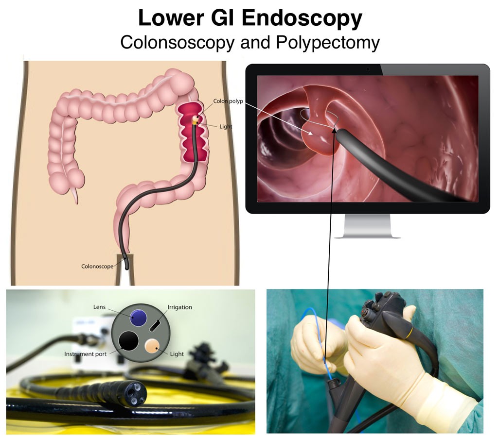 colonoscopy-procedures-by-dr-mona-dave-pediatric-gastroenterologist