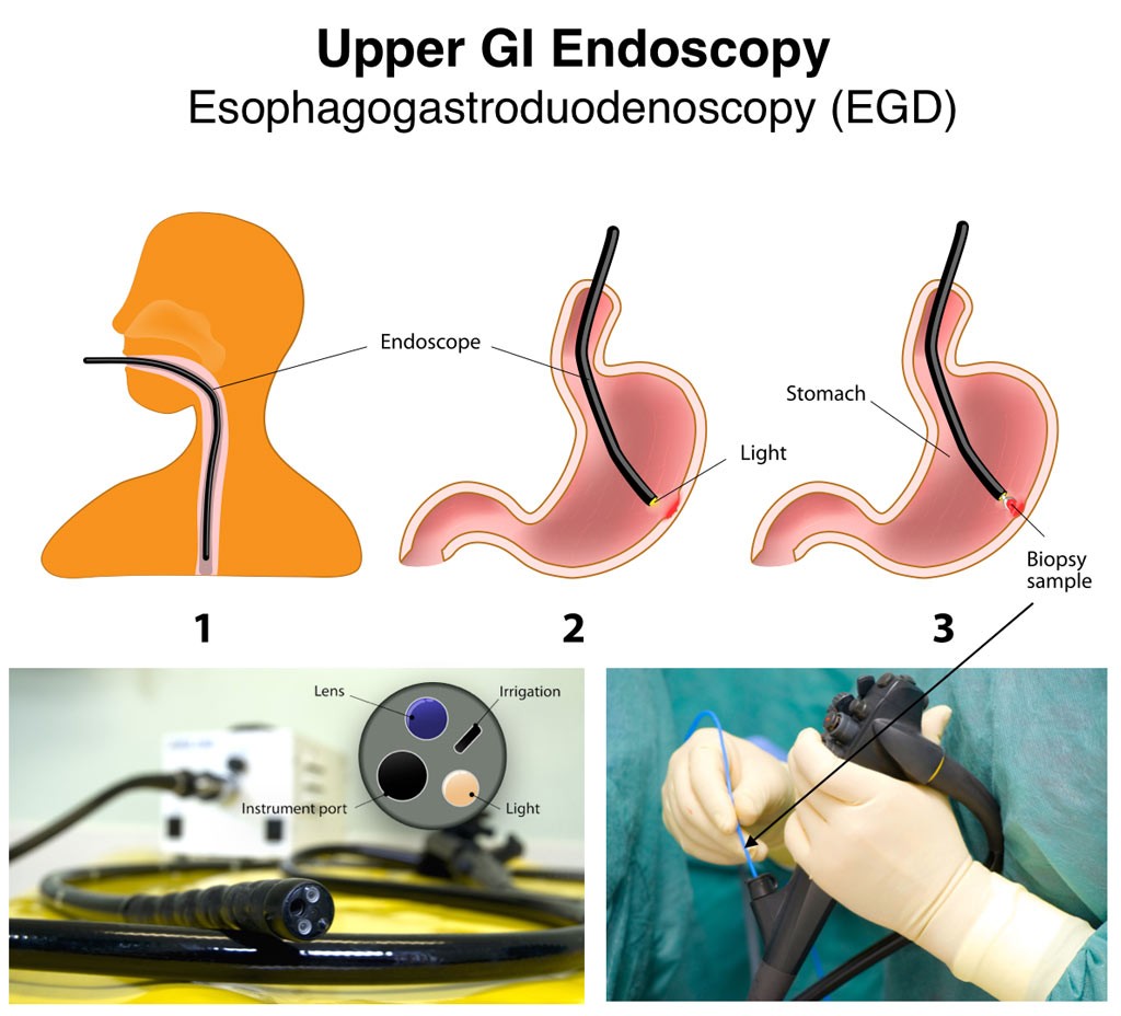 EGD Procedures by Dr. Mona Dave, Pediatric Gastroenterologist in