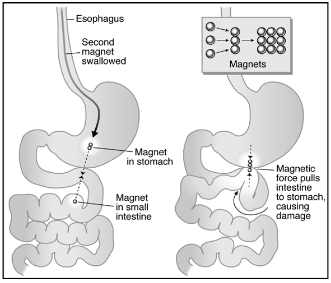 high powered magnets swallowing