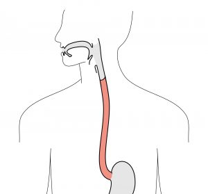 eosinophilic esophagitis