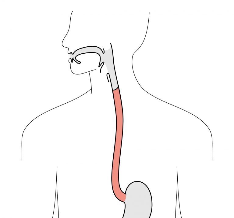 What's Eosinophilic Esophagitis? — Pediatric Gastroenterologist