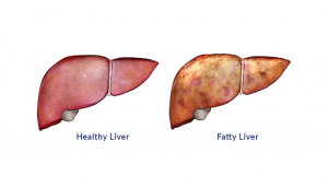 Unhealthy vs healthy liver | Pediatric Gastroenterology - Mona Dave, MD