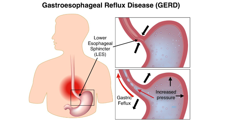 What is acid reflux why